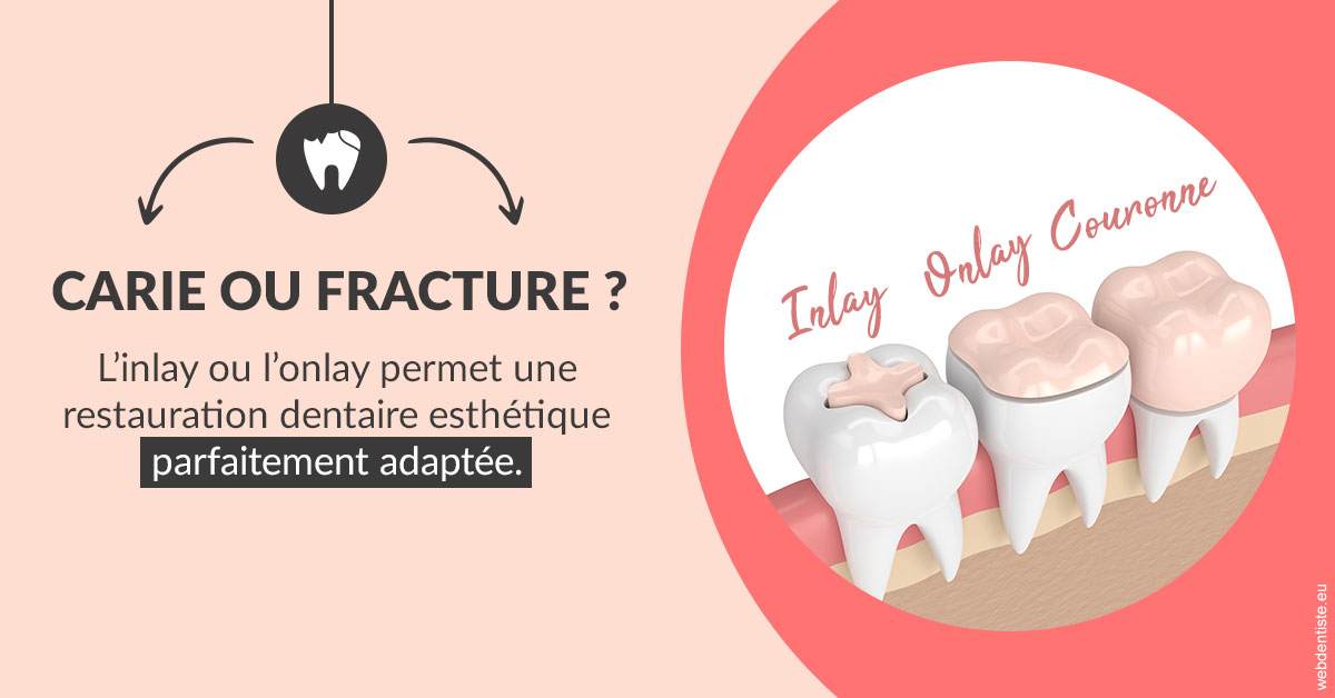 https://dr-monlouis-deva-michele-sandra.chirurgiens-dentistes.fr/T2 2023 - Carie ou fracture 2