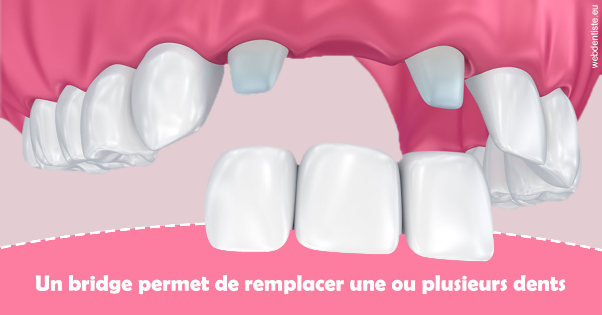 https://dr-monlouis-deva-michele-sandra.chirurgiens-dentistes.fr/Bridge remplacer dents 2