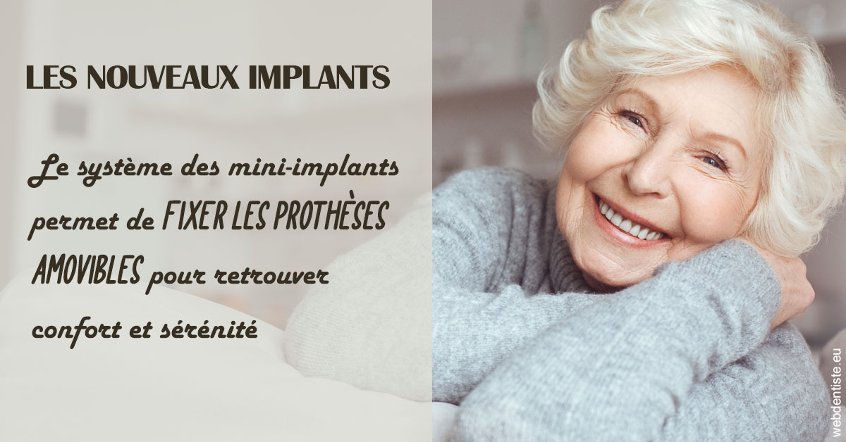 https://dr-monlouis-deva-michele-sandra.chirurgiens-dentistes.fr/Les nouveaux implants 1