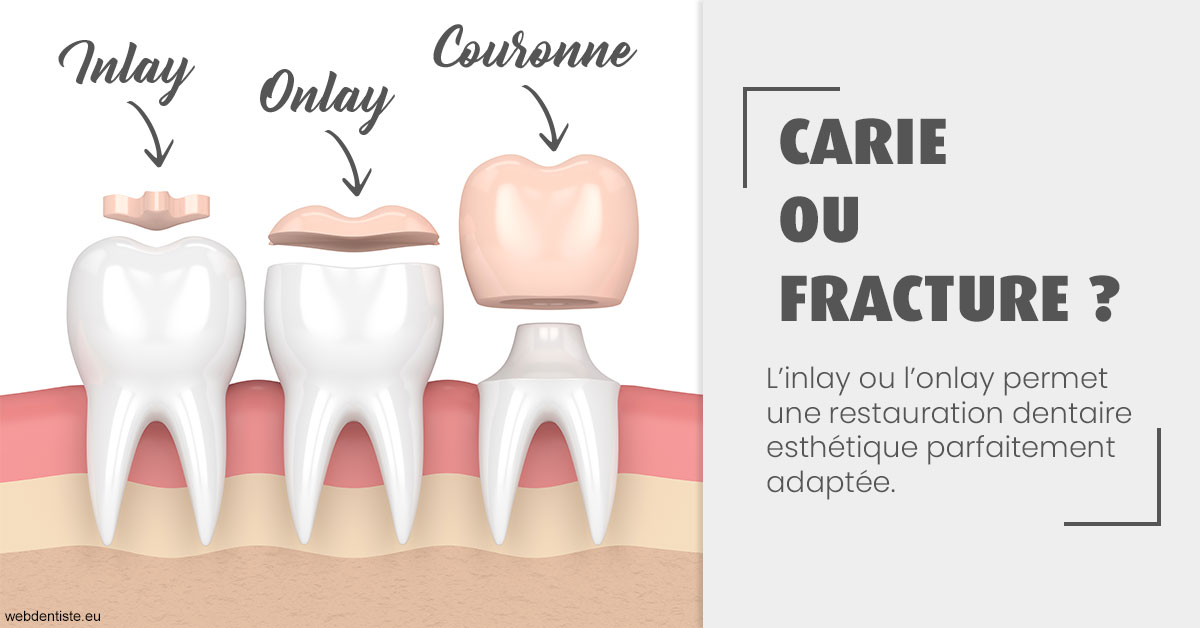 https://dr-monlouis-deva-michele-sandra.chirurgiens-dentistes.fr/T2 2023 - Carie ou fracture 1