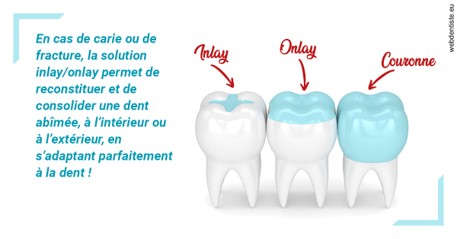 https://dr-monlouis-deva-michele-sandra.chirurgiens-dentistes.fr/L'INLAY ou l'ONLAY