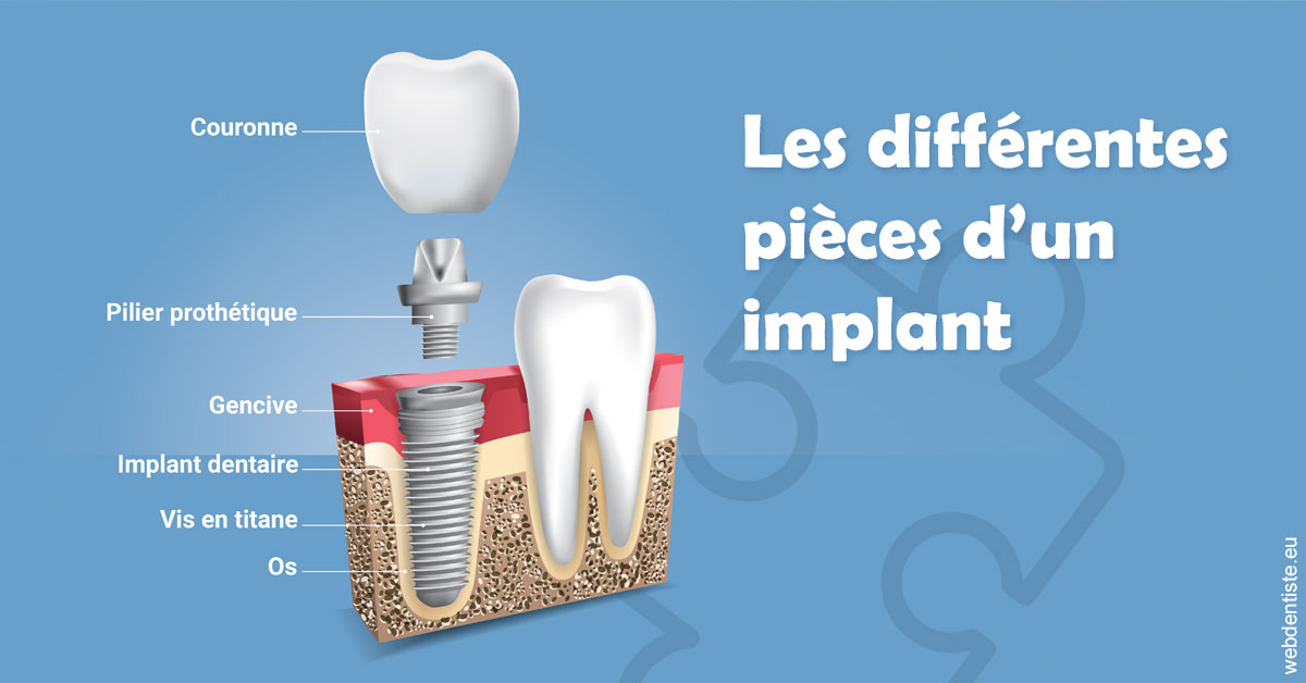 https://dr-monlouis-deva-michele-sandra.chirurgiens-dentistes.fr/Les différentes pièces d’un implant 1